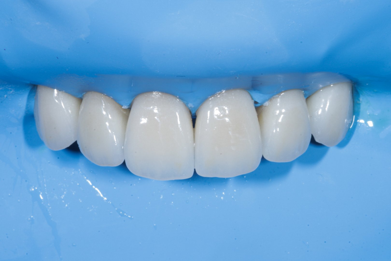 Preparation for porcelain veneers placement