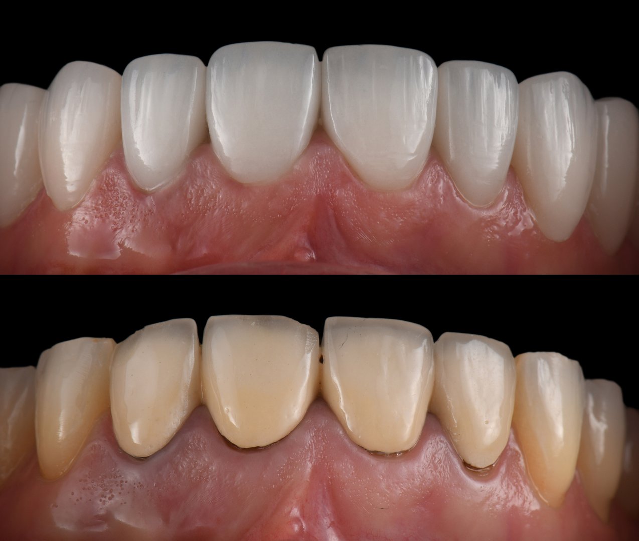 emax ceramic veneers