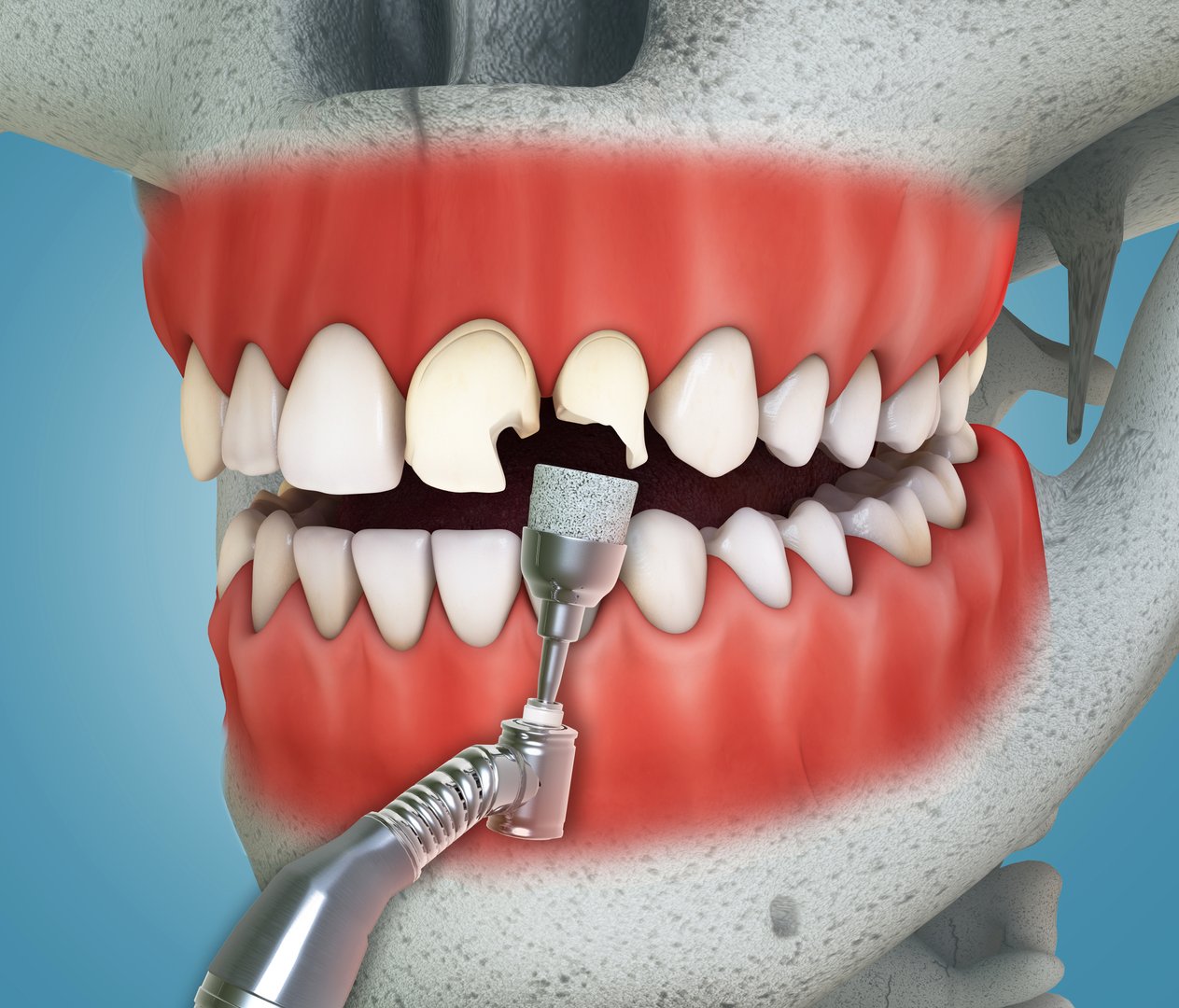 Veneers installation procedure.Medically accurate 3D illustration.
