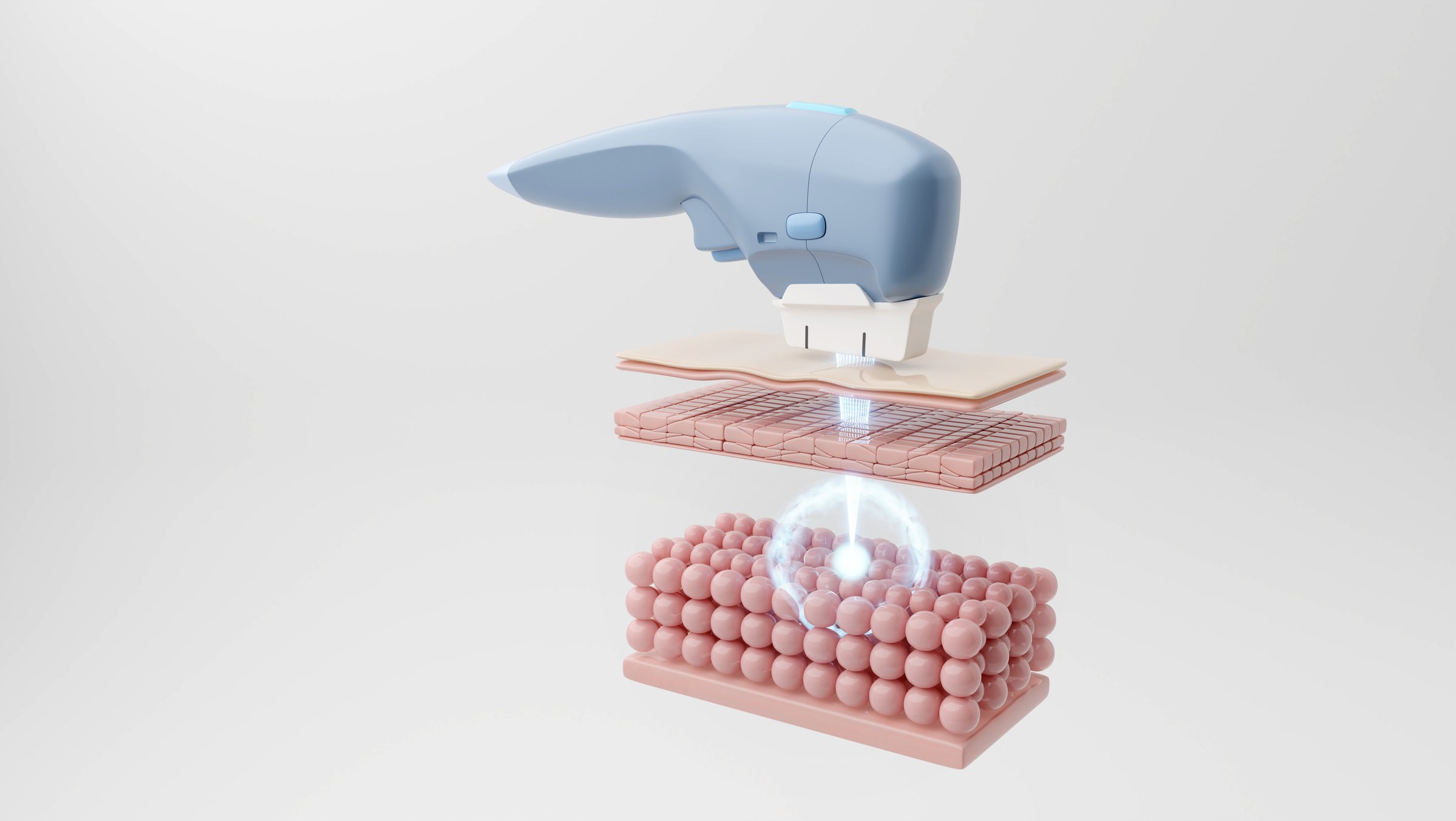 Ultherapy laser or HIFU laser targets SMAS through skin layers. 3D rendering.