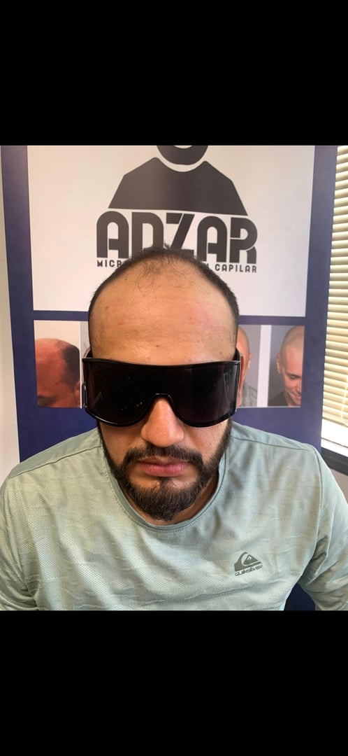 Before and After Scalp Micropigmentation Results - Real Client Transformation