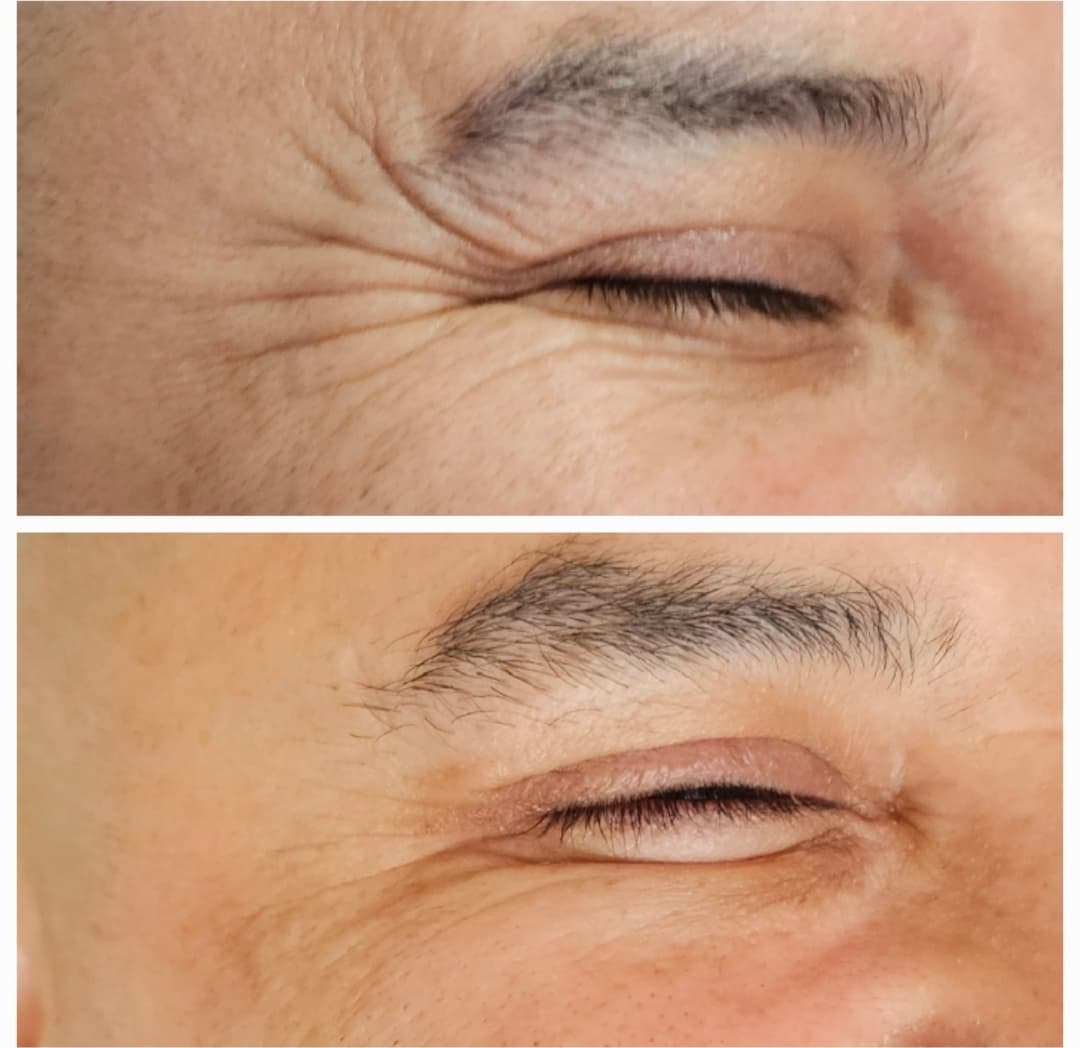 Resultado del tratamiento