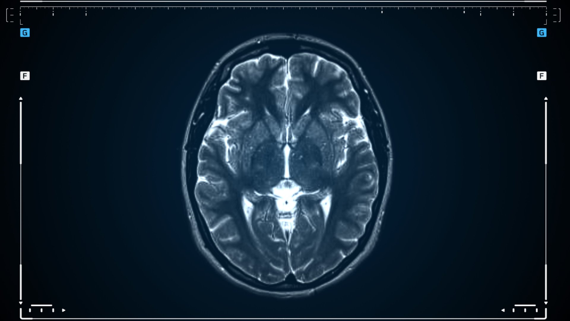 Brain MRI scan. Scanning of brain's magnetic resonance image. Diagnostic Medical Tool