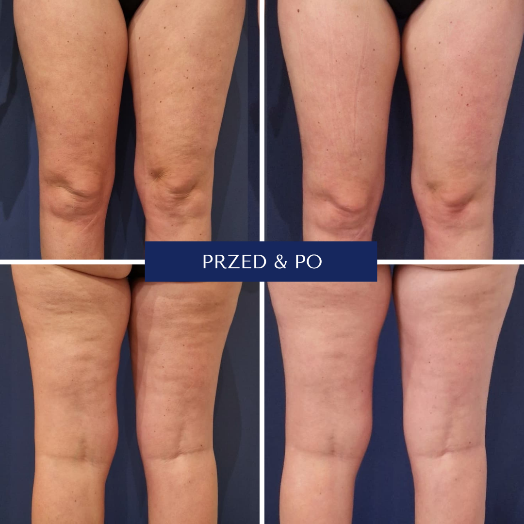 Magnifico efekty przed i po zabiegu 2