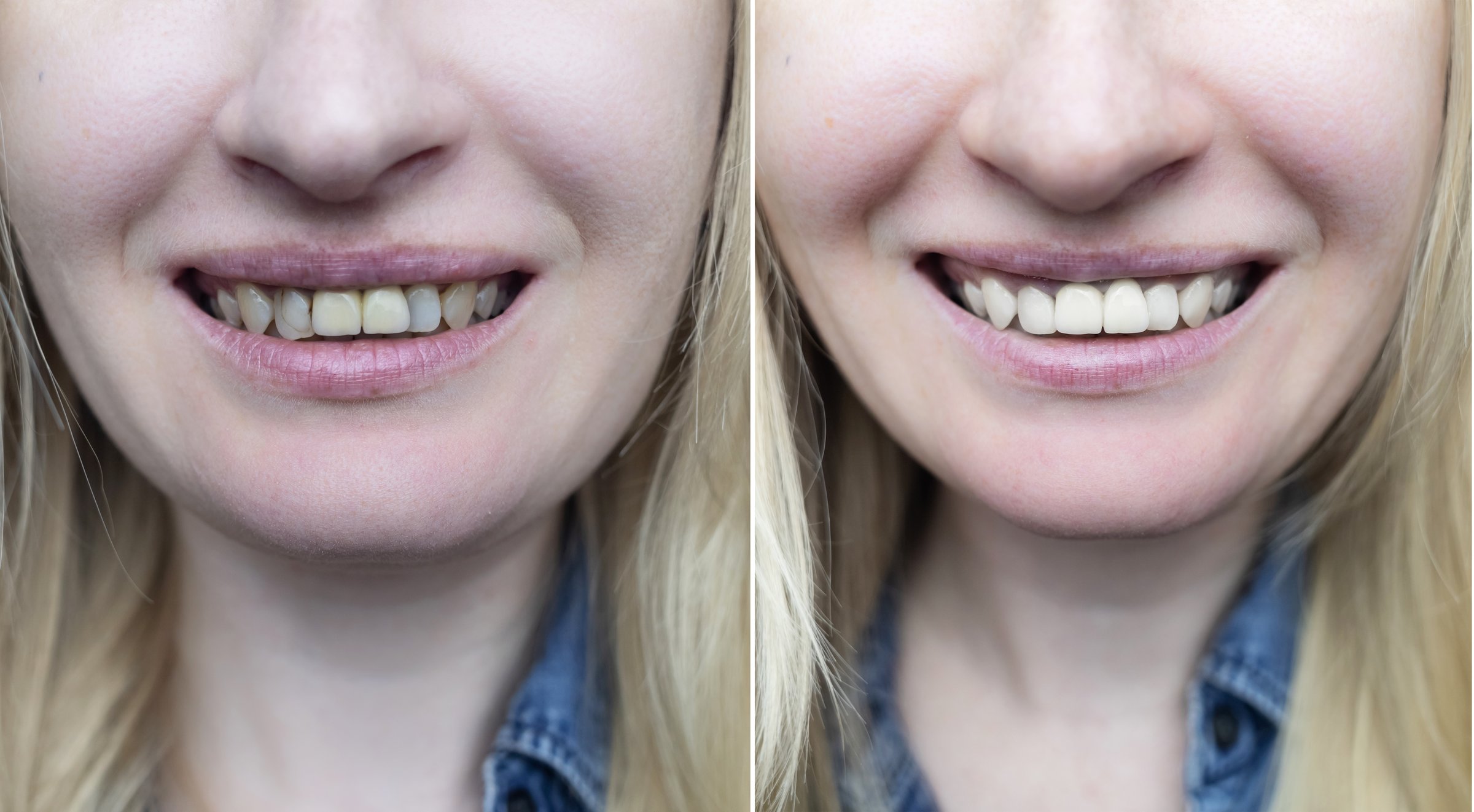 Successful restoration of front incisors