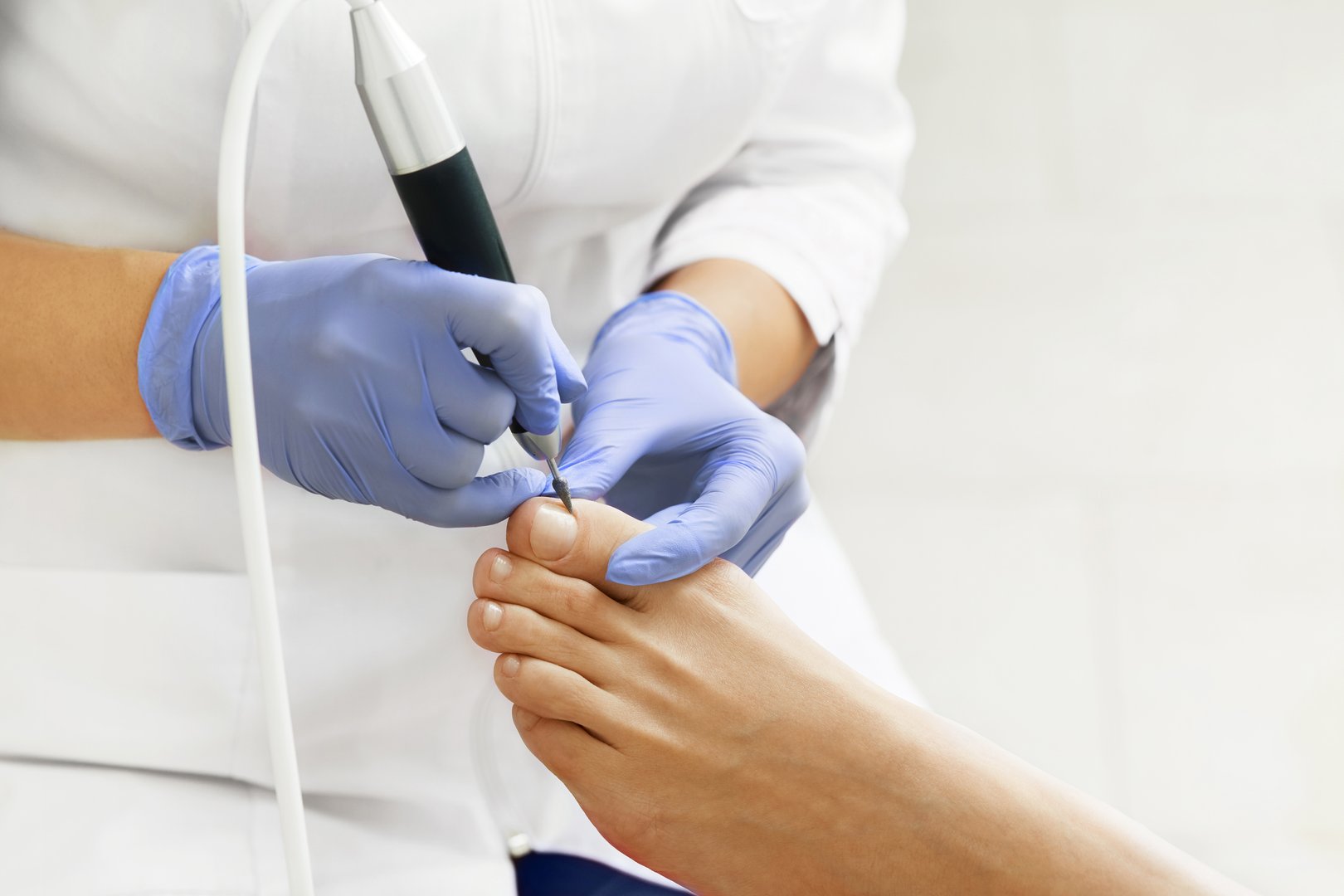 Corn and Callus Removal