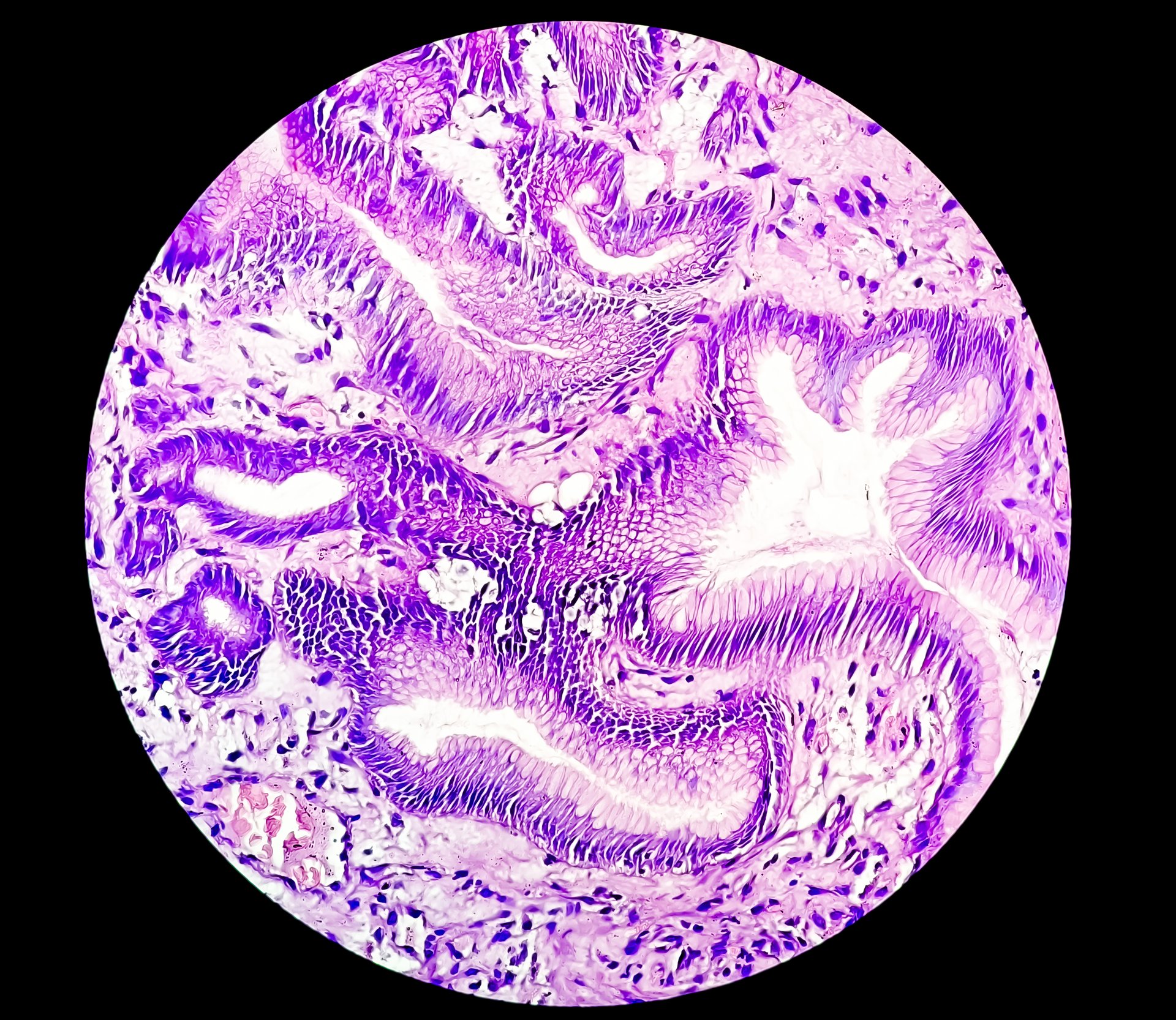 Biopsia gástrica mostrando adenocarcinoma grado 3