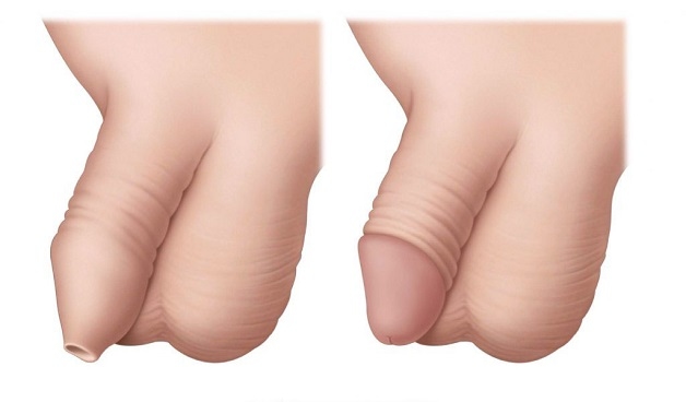 Dài bao quy đầu: nhận biết, tác động và hướng xử lý