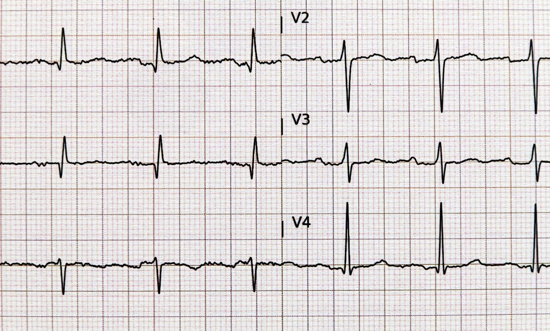 Close-up of a standard electrocardiogram, EKG, graph paper. Health and medical concepts.