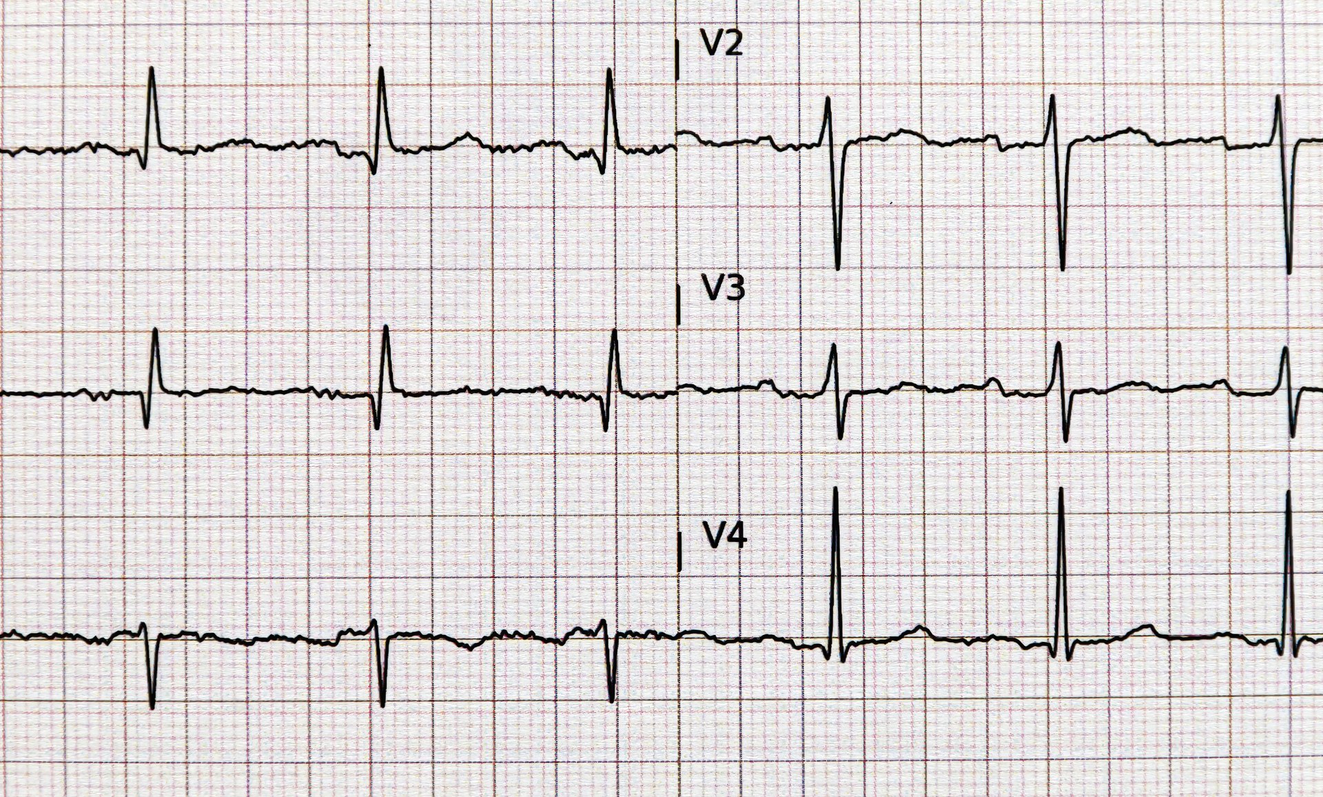 Close-up of a standard electrocardiogram, EKG, graph paper. Health and medical concepts.