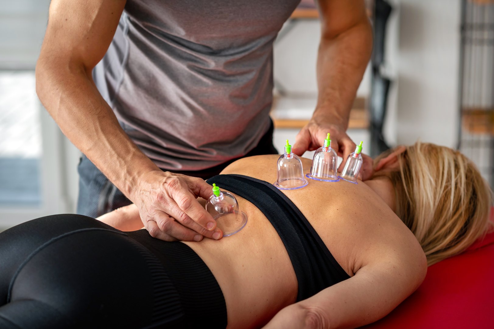 Physiotherapist placing vacuum cups on woman's back during cupping therapy session