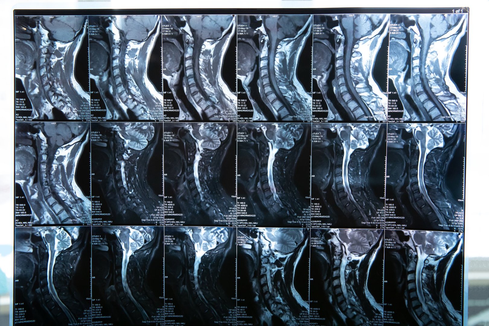 Detailed Cervical Spine MRI Scans for Medical Analysis