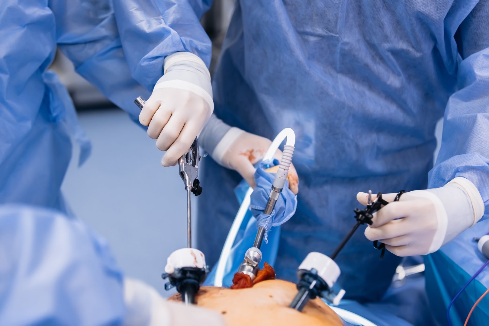 Professional surgeons in the operating room. Instrument for laparoscopic surgery. A surgeon performs laparoscopic gastric surgery in the operating room.