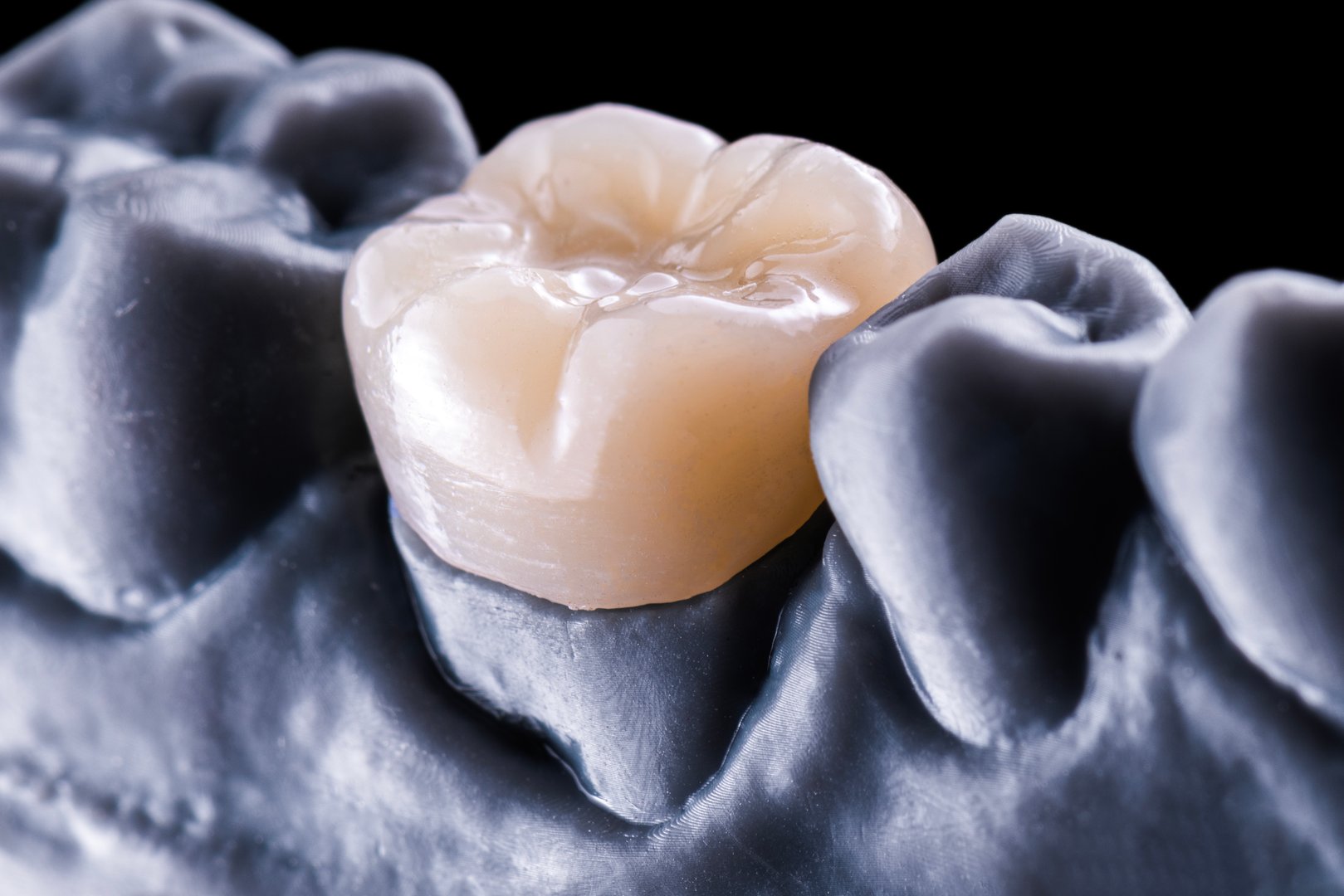 ceramic emax crowns