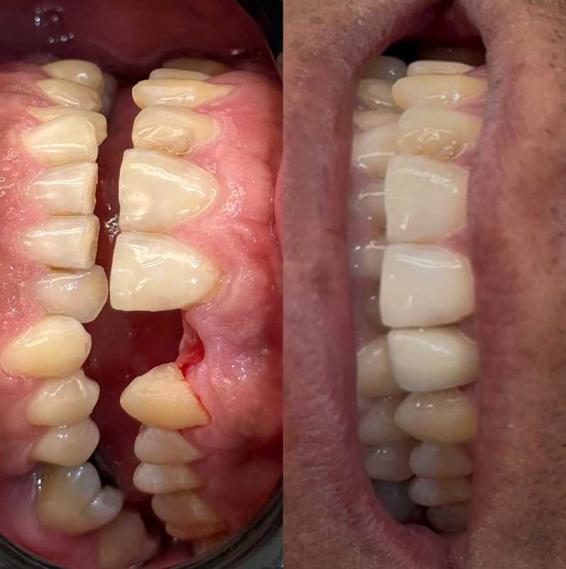 Implantes Dentários - Resultado