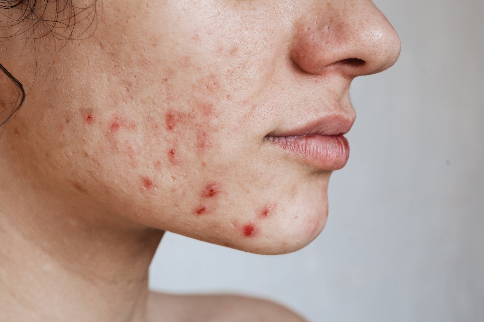 Close-up of the skin of a young girl with problems. Pimples, acne, pores, scars. Natural skin without filters.