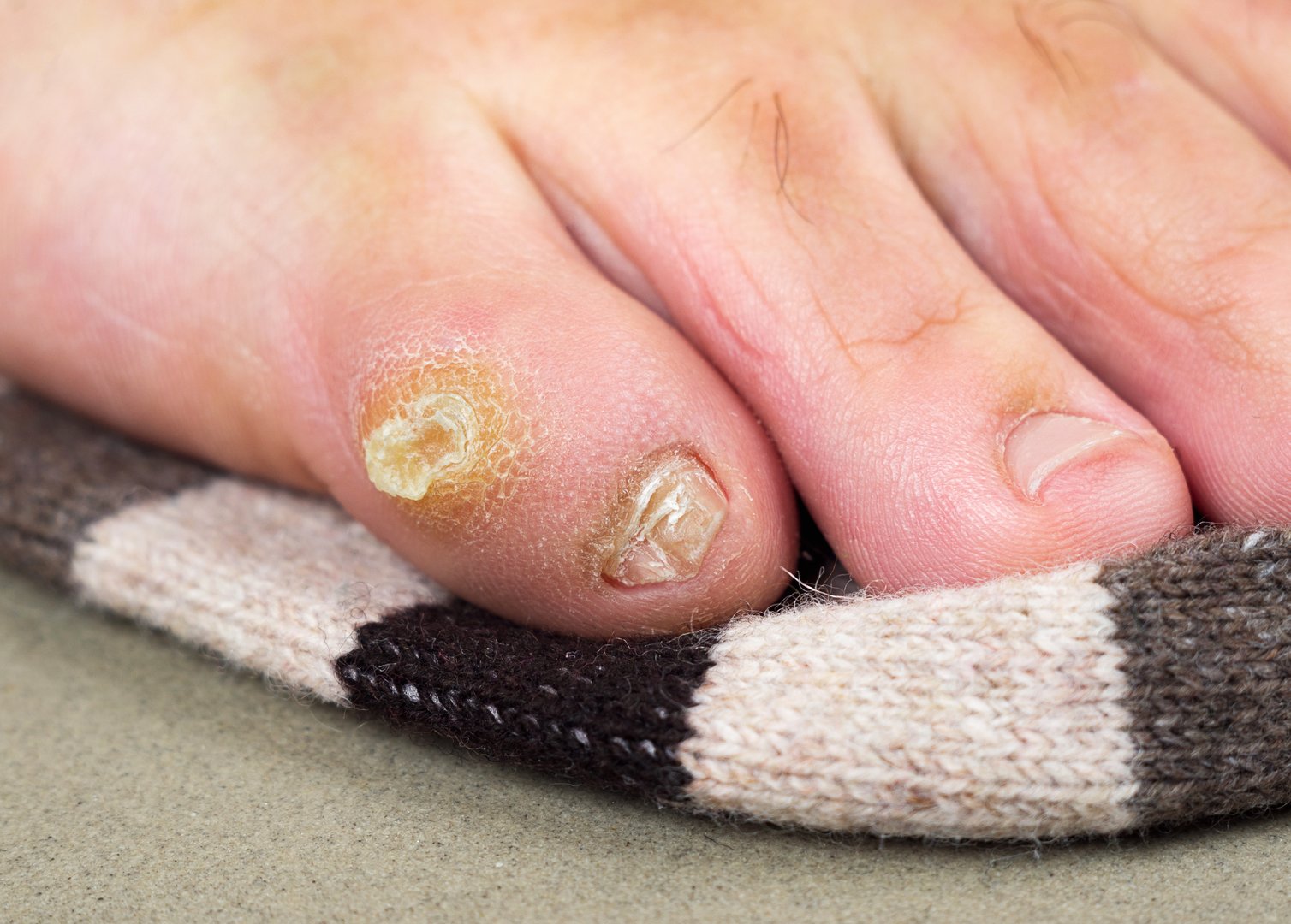 Big dry callus and misshapen nail on the little toe of a man&#039;s foot. Consequences of wearing uncomfortable, tight shoes.