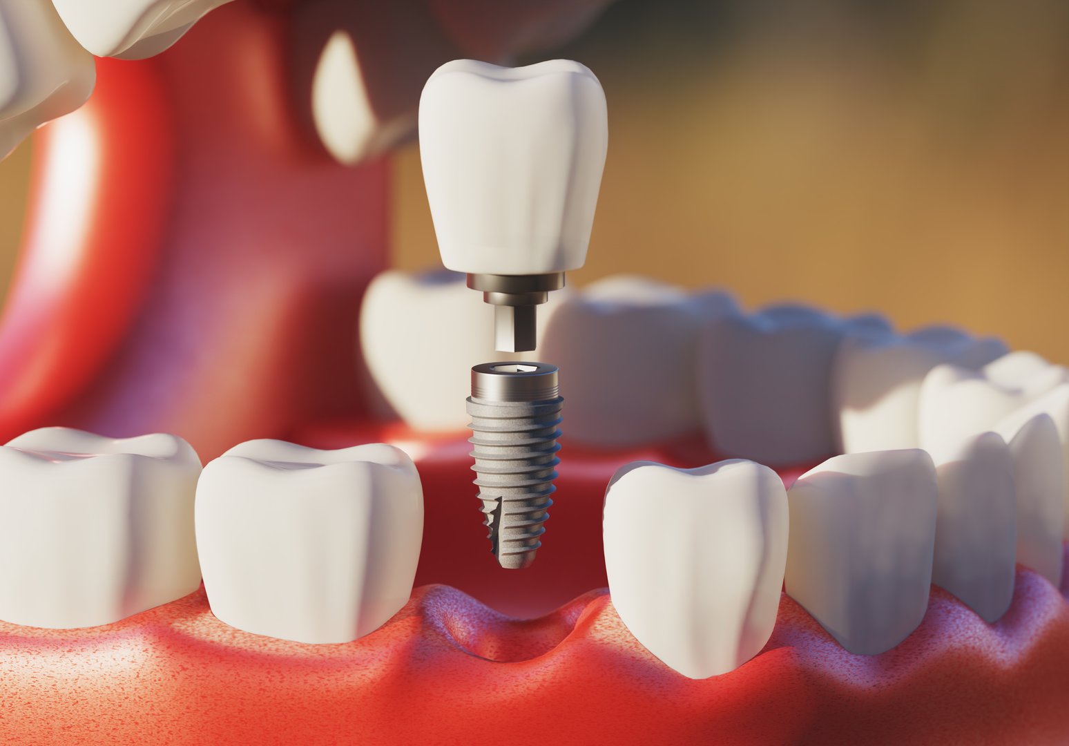 Dental implant screw, placement procedure. 3d Illustration