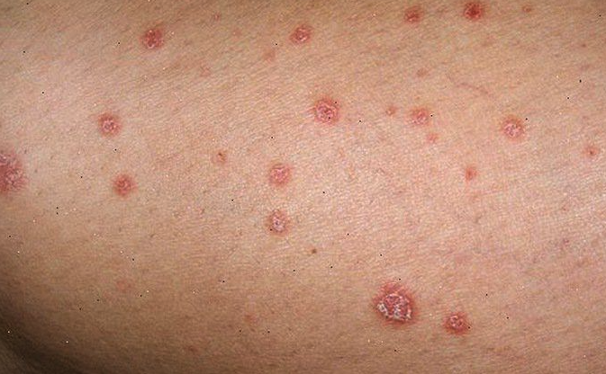 Hình ảnh minh họa hậu quả bệnh lậu