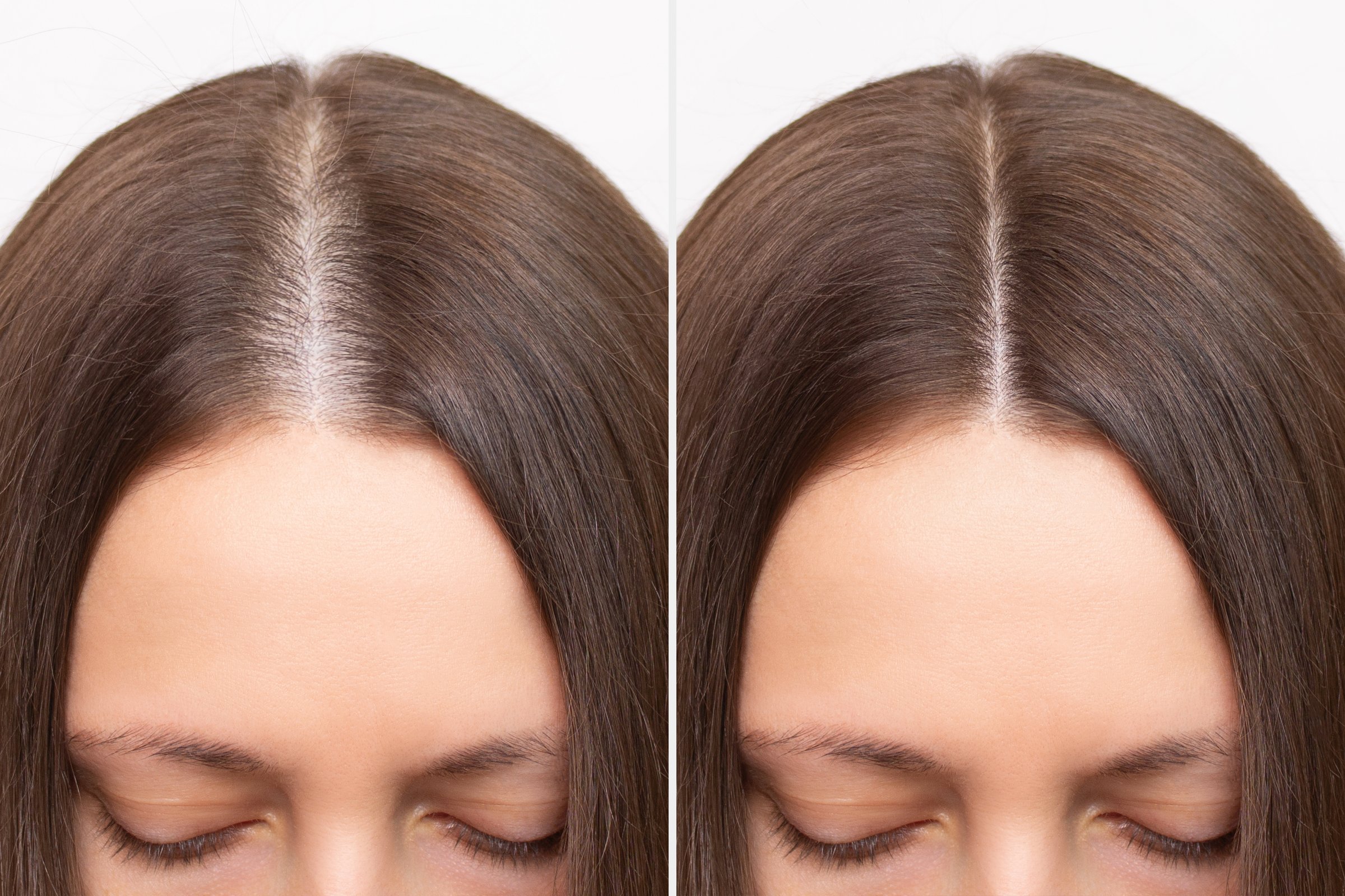 Young woman hair loss treatment before and after in Bradenton FL - female pattern baldness SMP results at CC Styling Studio Bradenton clinic