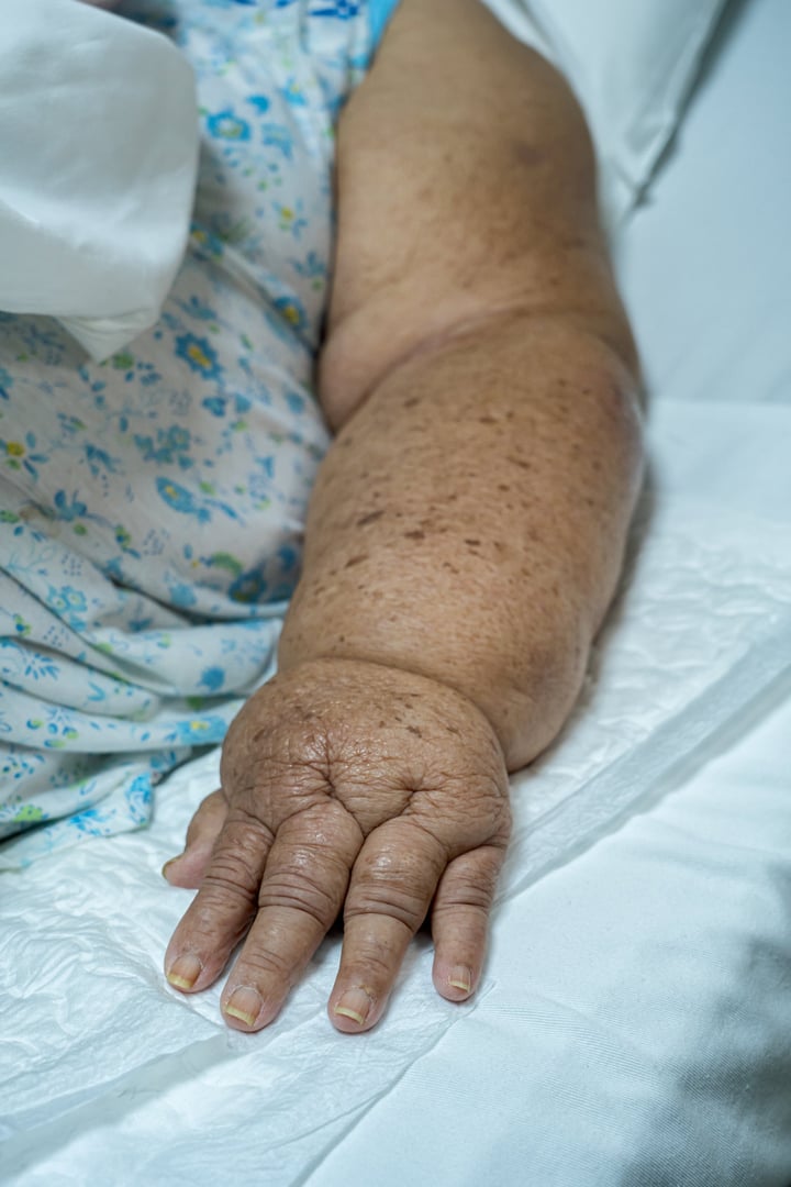 Lymphatic edema in a elderly female due to axillary emptying for breast cancer