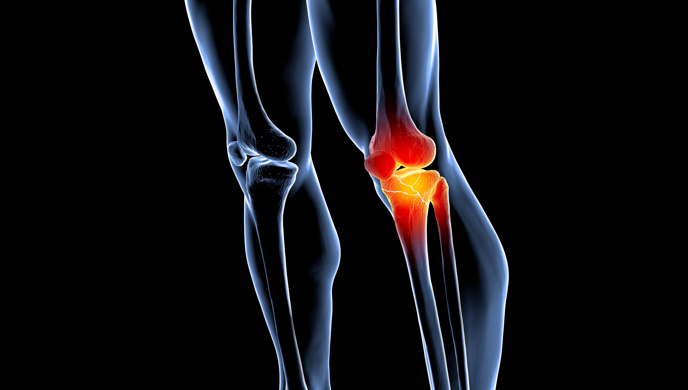This image conveys a broken lower femur refers to a fracture in the lower portion of the femur bone, which is the thigh bone. This type of fracture typically occurs due to trauma, such as a fall or a direct blow to the leg. Symptoms include severe pain, swelling, bruising, and difficulty moving the affected leg.