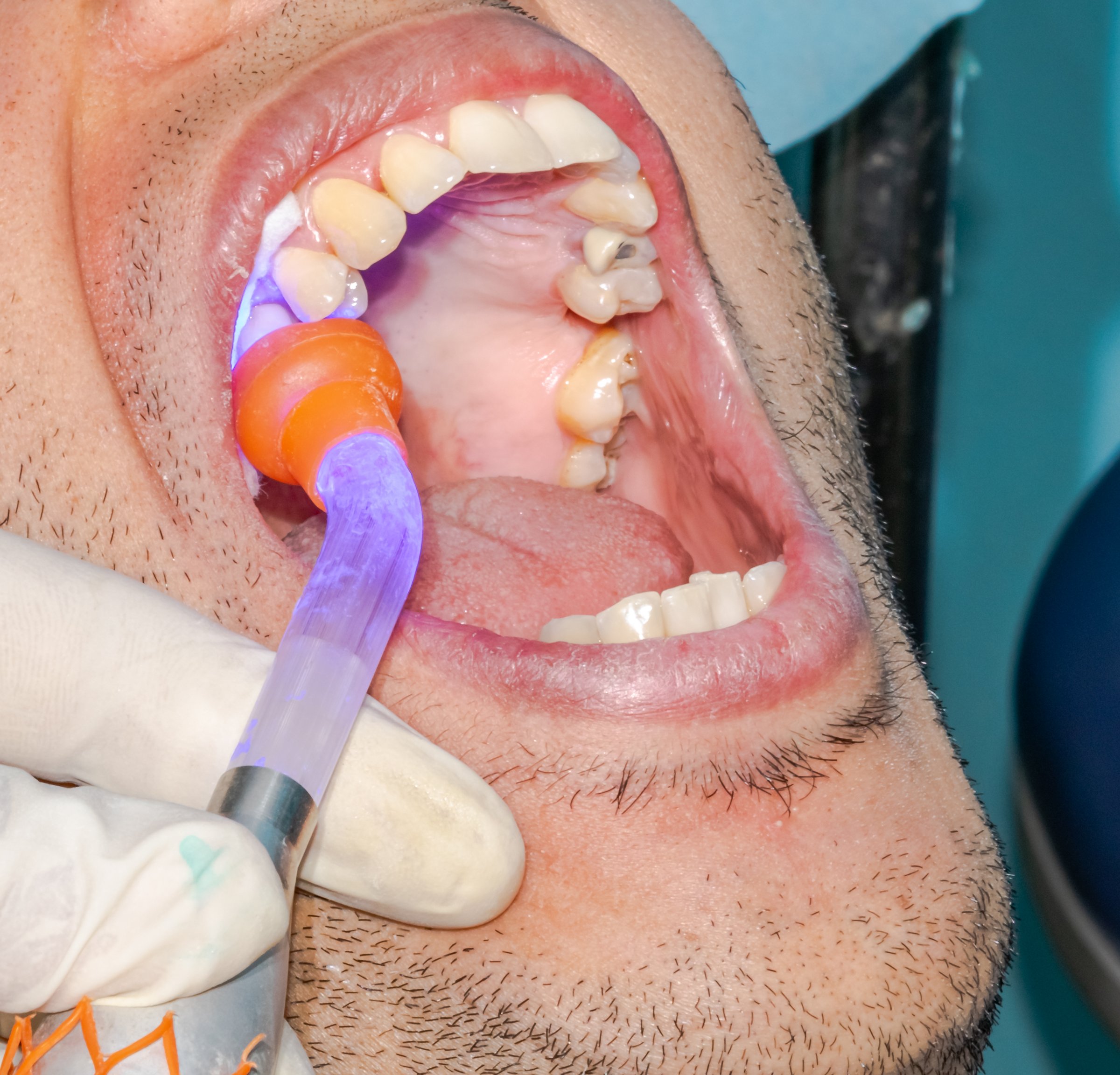 Procedimiento de resina dental profesional