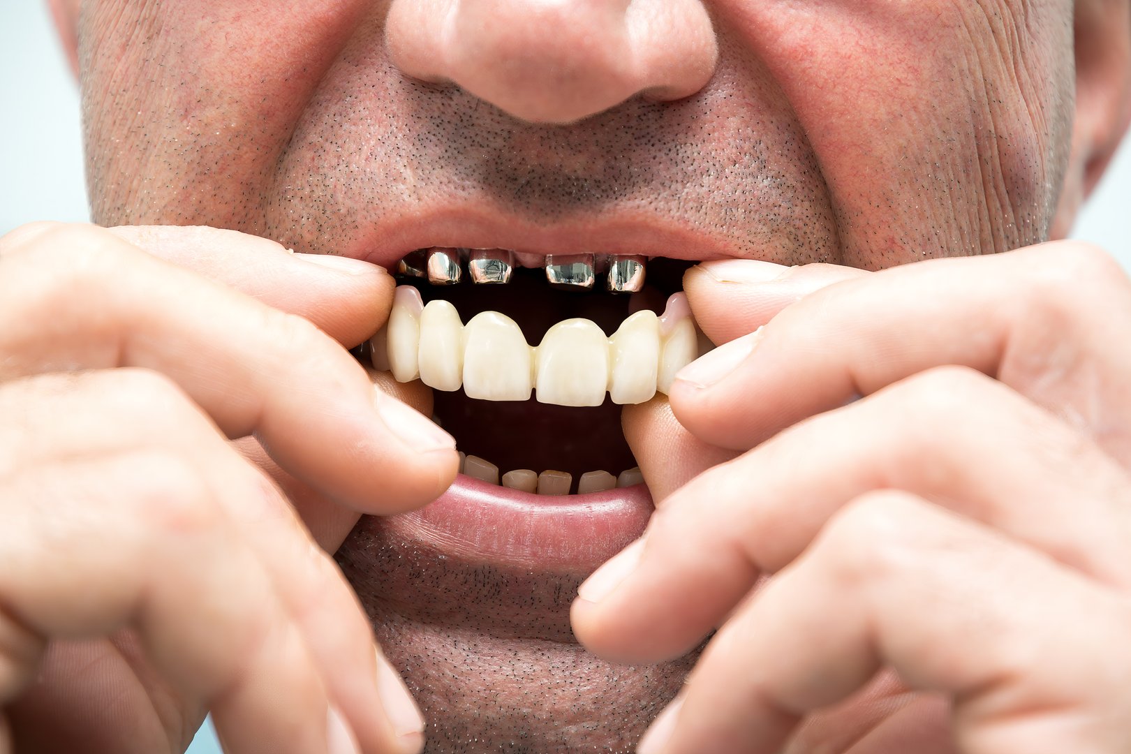 Close-up of a man's hands putting new dentures on metal crowns. Telescopic prostheses. One photo from a series. There are before and after photos. Real life.