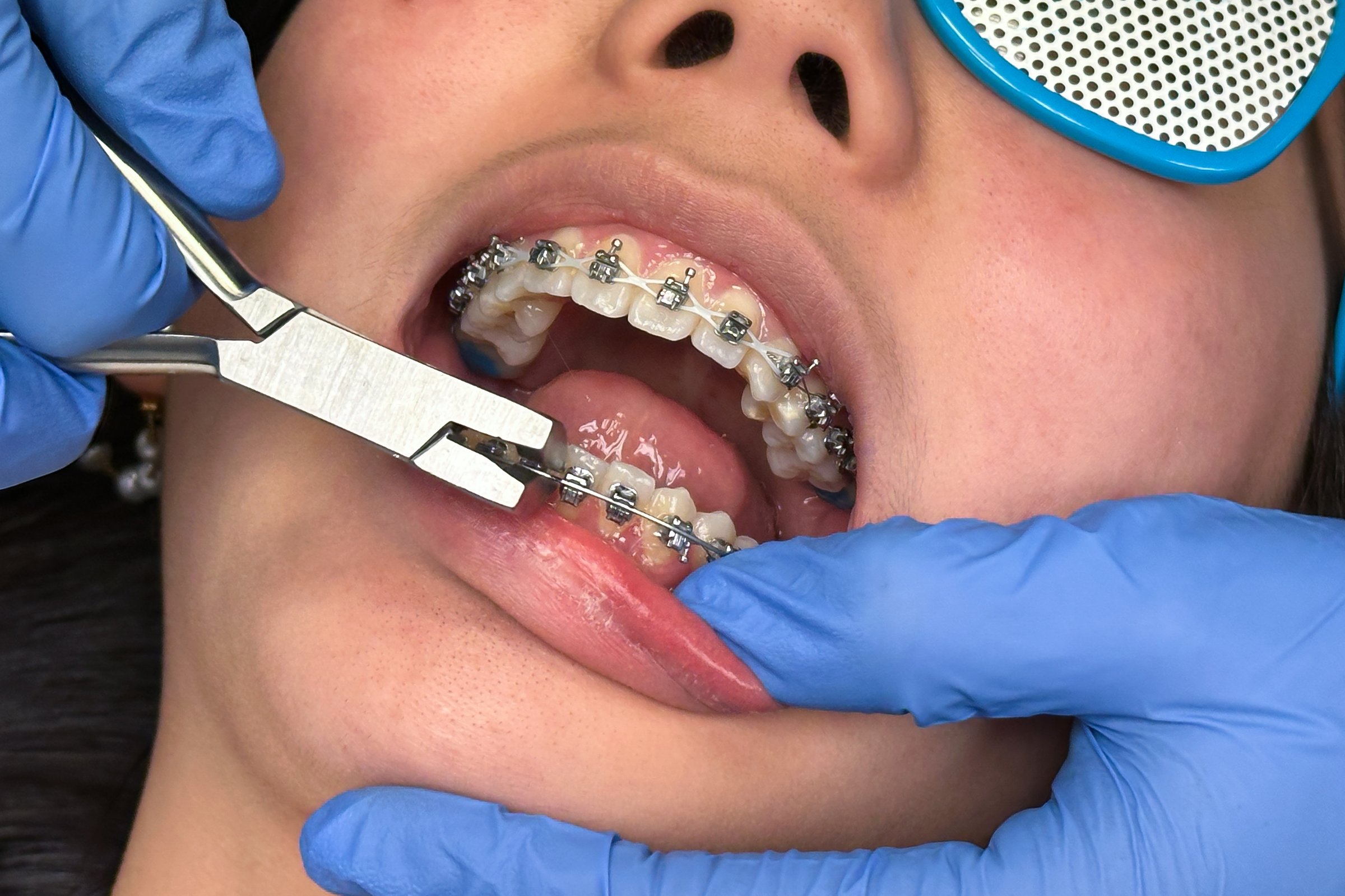 Dentist is installing braces on a teenage girl at the orthodontist clinic.
