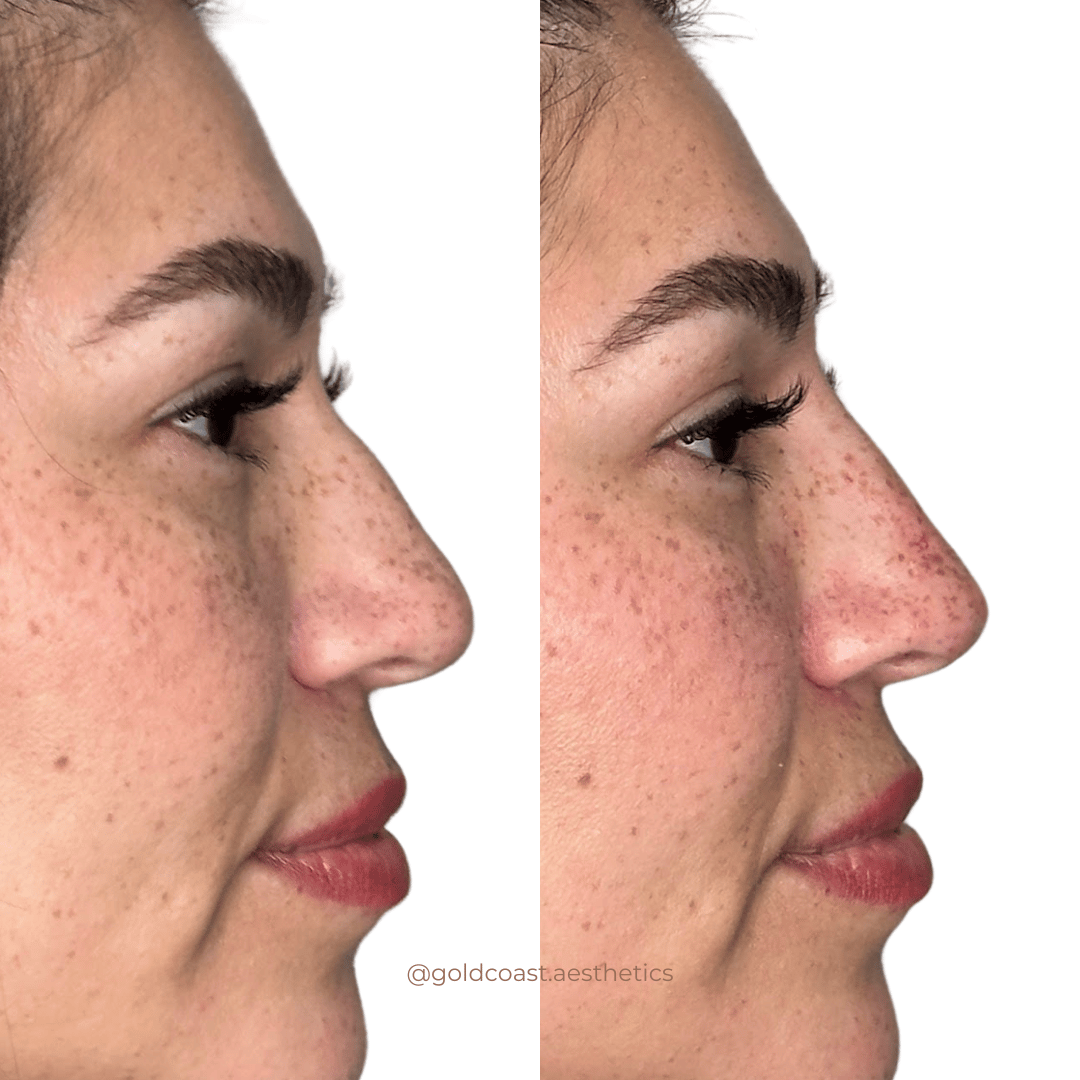 Non-surgical nose reshaping