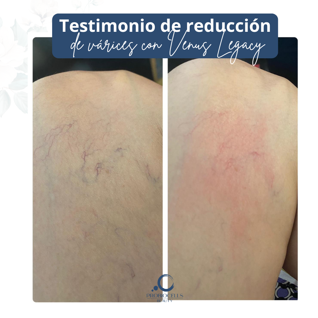Testimonio de medicina estética - Resultado de tratamiento completo