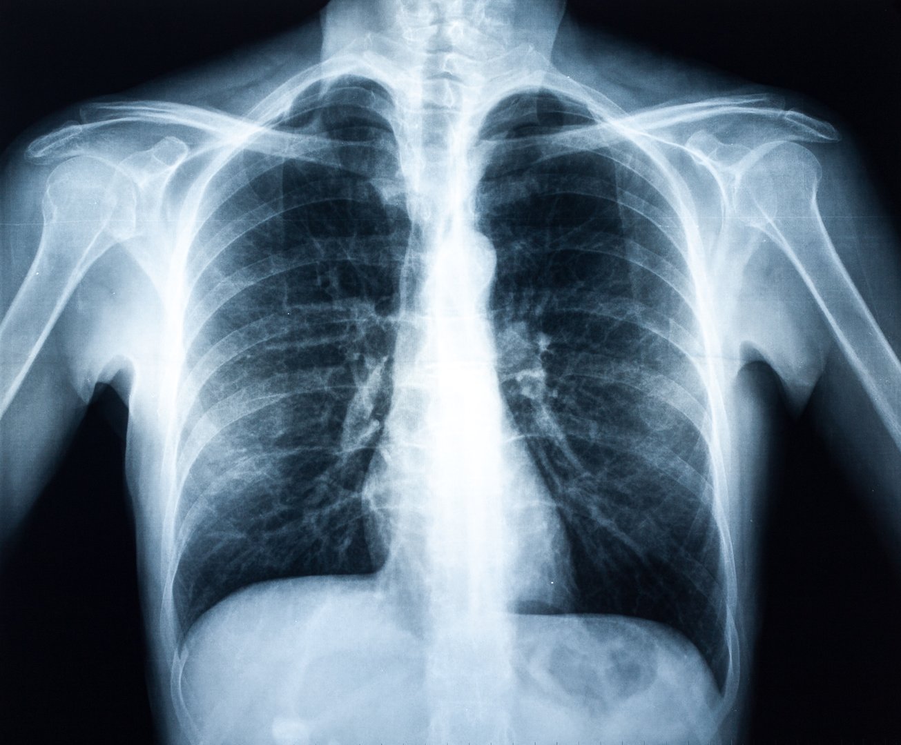 Xray of a human torax isolated