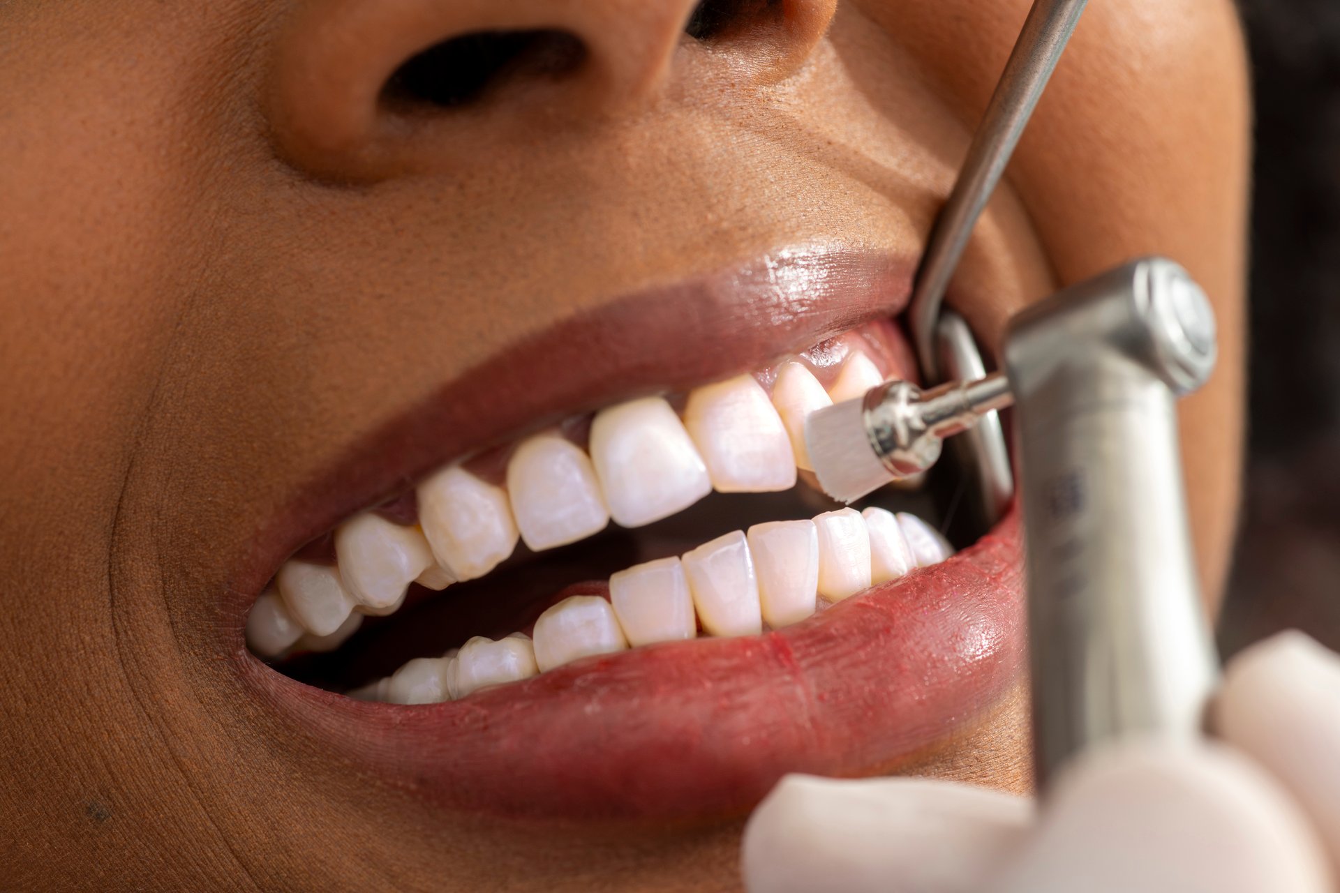 Close up view of a dentist polishing a patient's teeth with a dental drill, highlighting the precision and care in a dental clinic setting