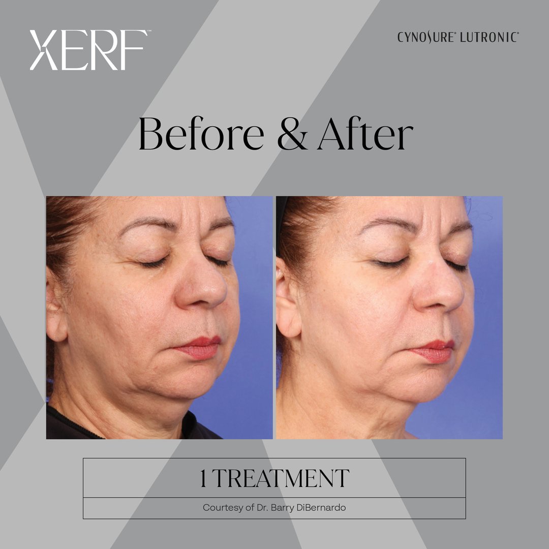 Xerf Advanced Aesthetic Technology