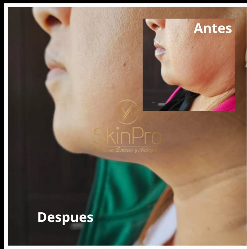 Resultado del tratamiento