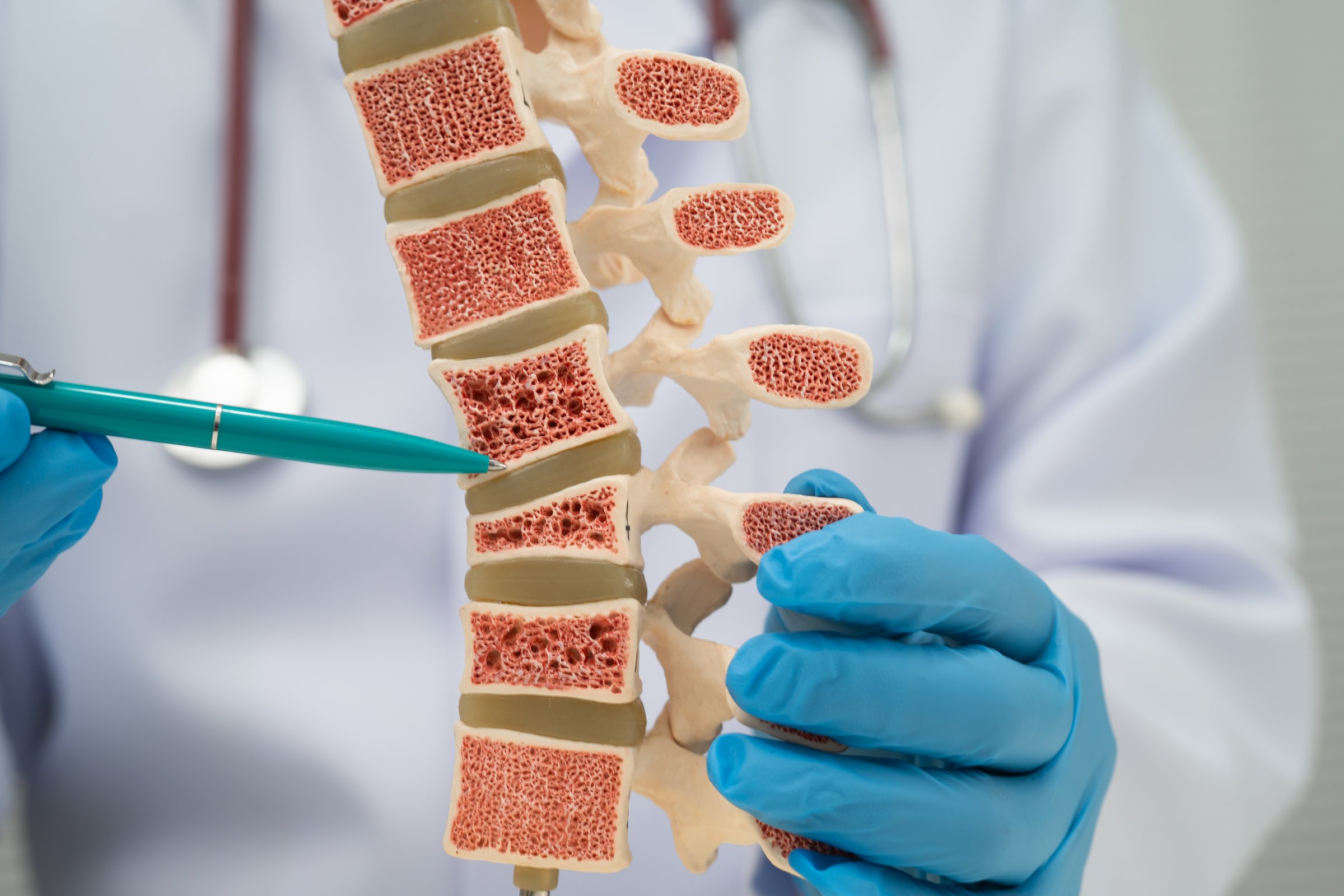 Doctor holding osteoporosis bone model