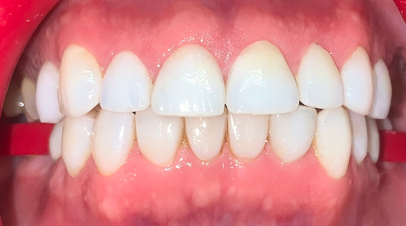 Después de tratamiento con carillas dentales