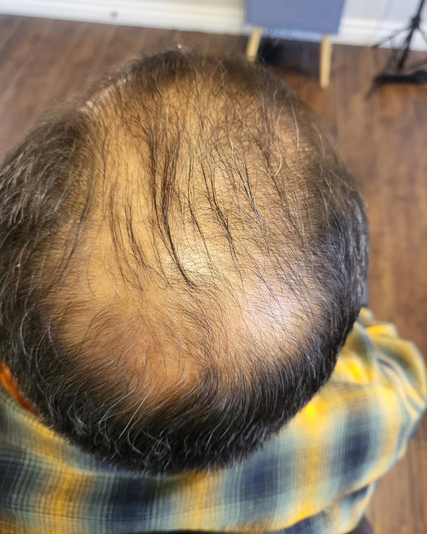 Before and After Scalp Micropigmentation Results - Real Client Transformation