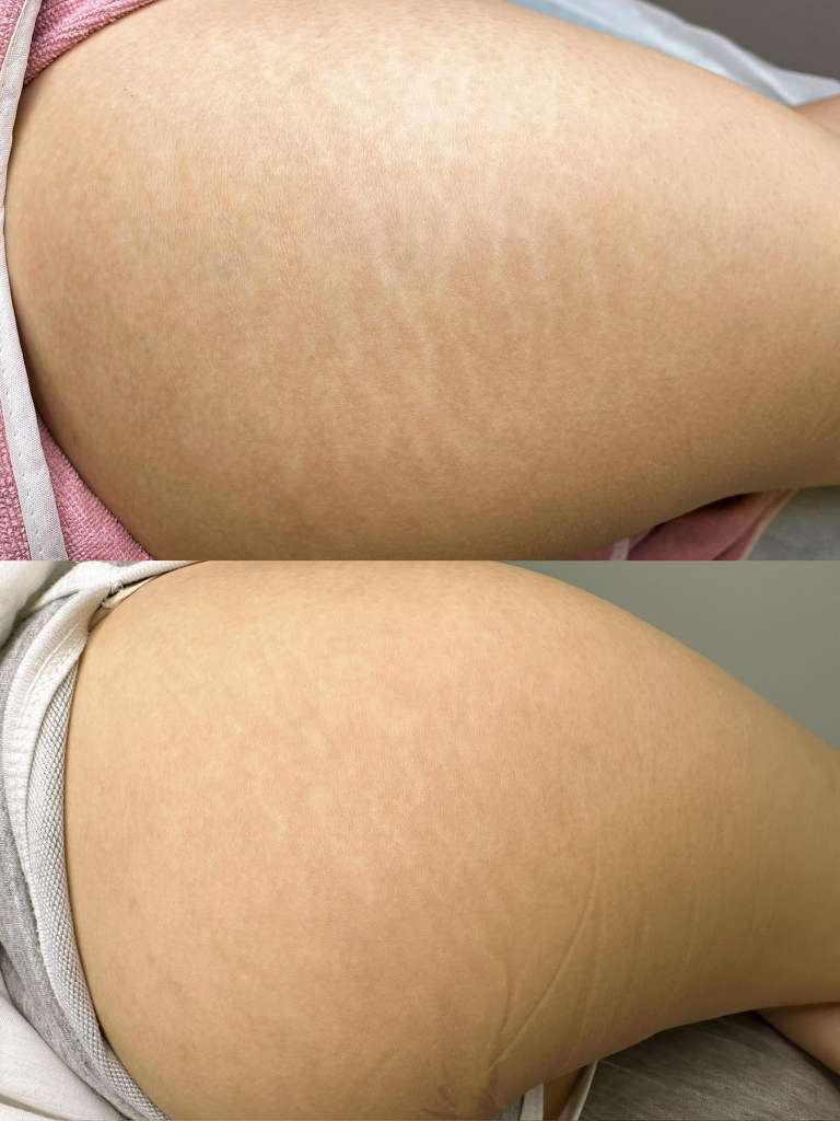 Stretch marks before and after treatment