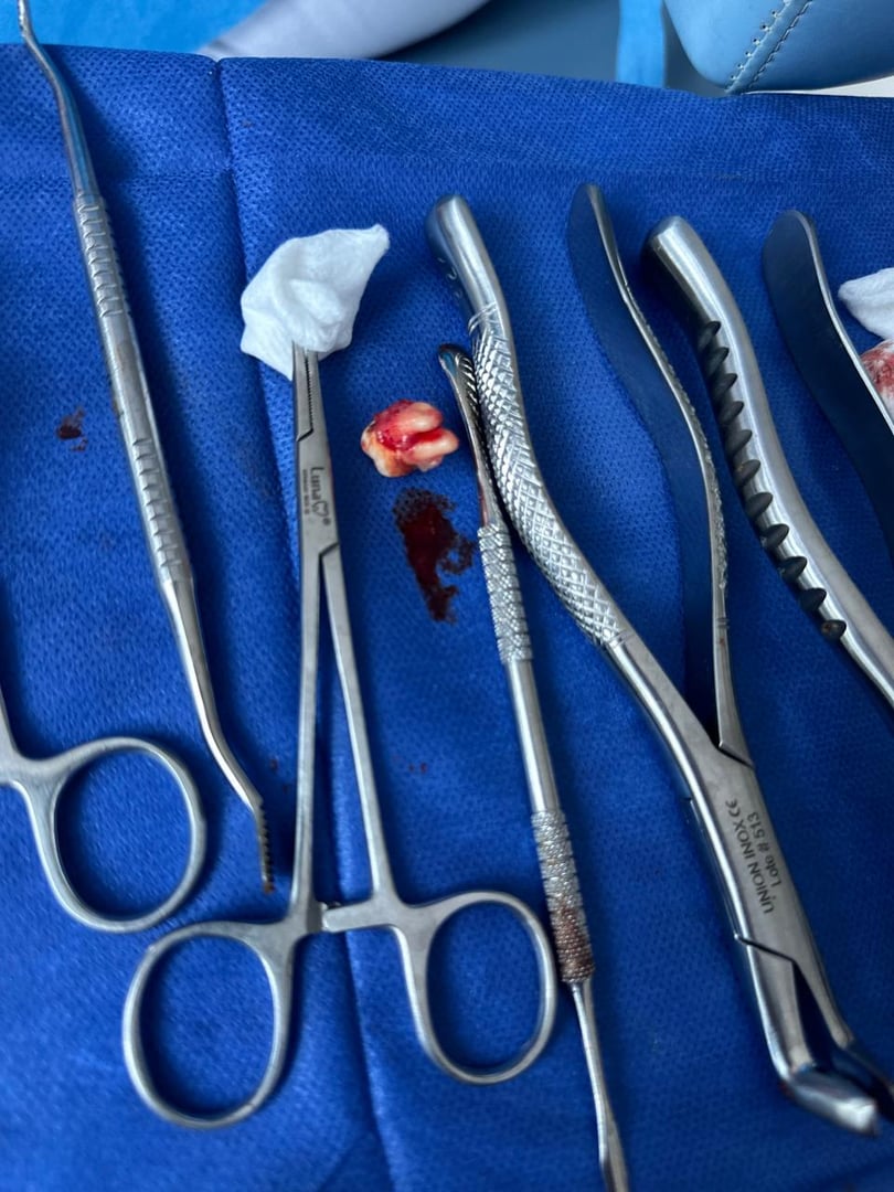 Extracciones Dentales - Dentista Marisol Contreras