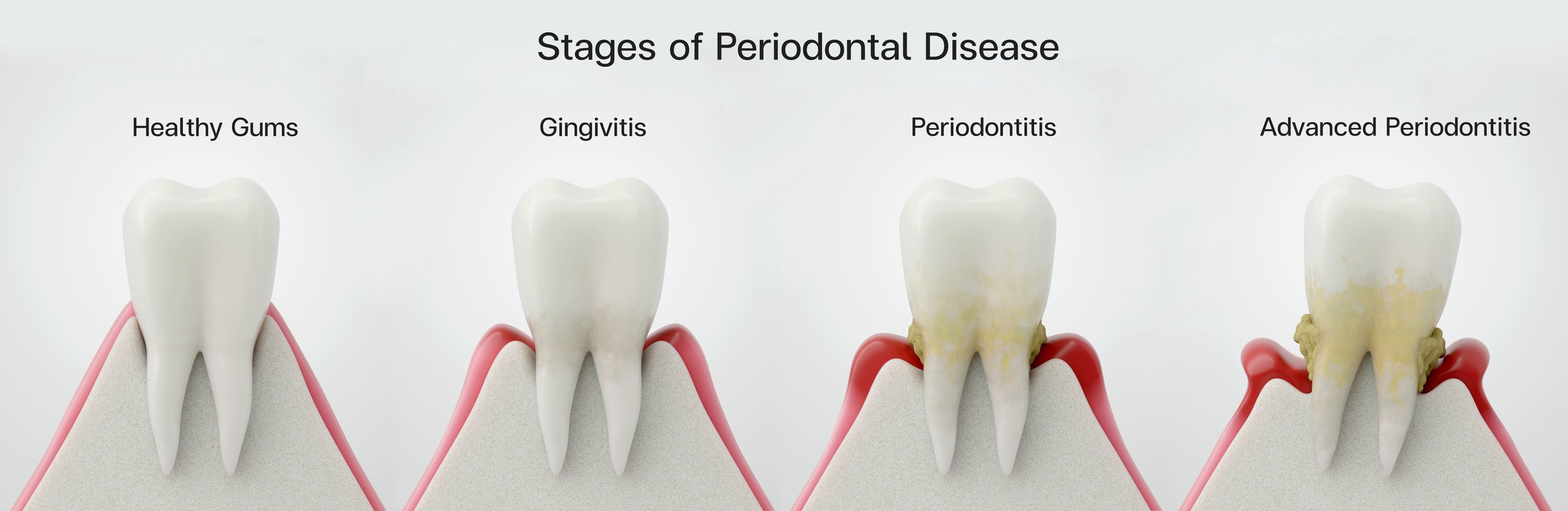 Progression of periodontal disease through four stages. Healthy, Gingivitis, Periodontitis, and Advanced. 3D Explainer.