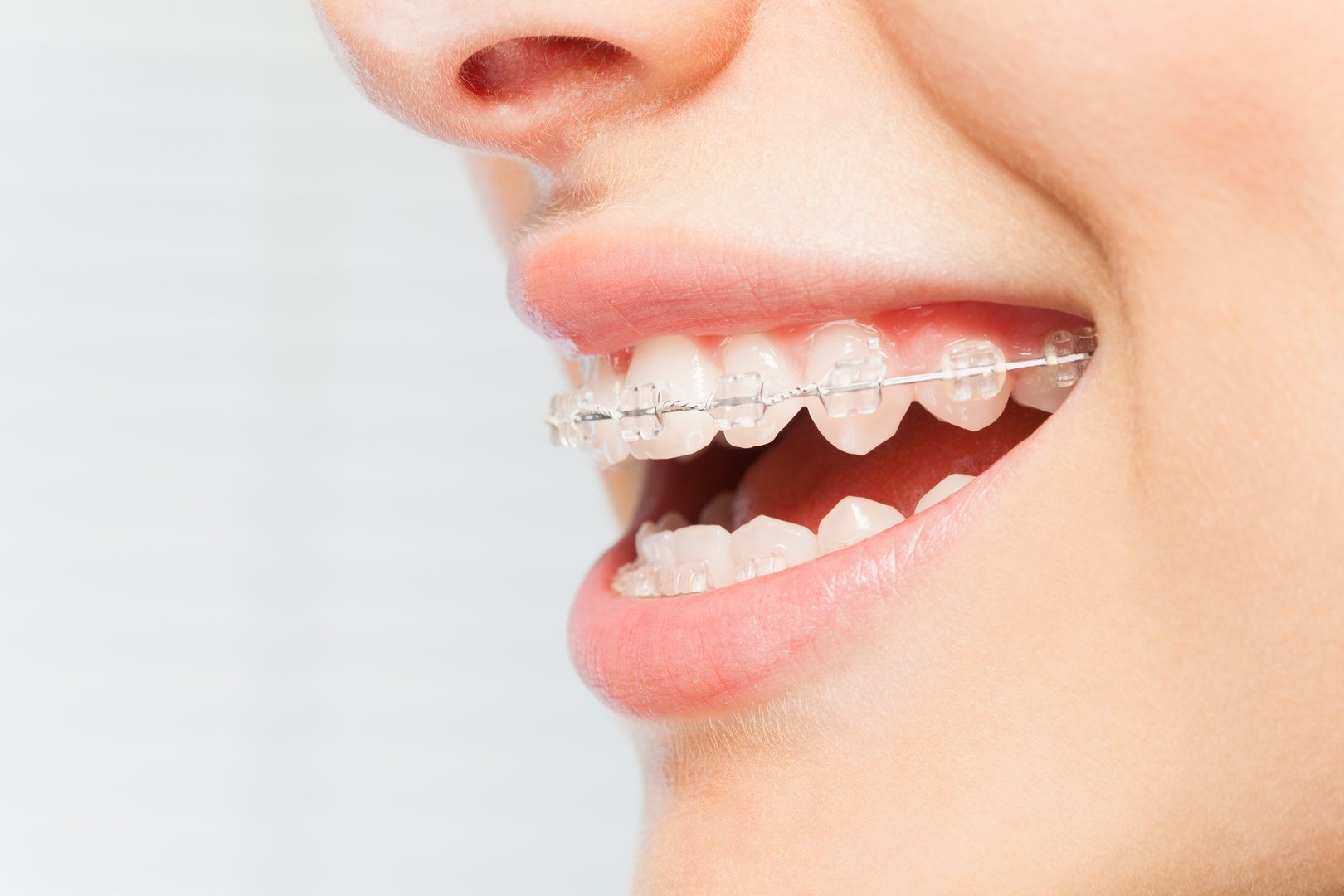 how ceramic braces work step by step