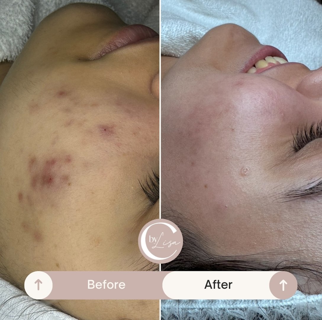 Resultados de tratamiento facial - Antes y Después