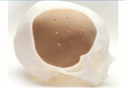 Implante Craneal de PEEK