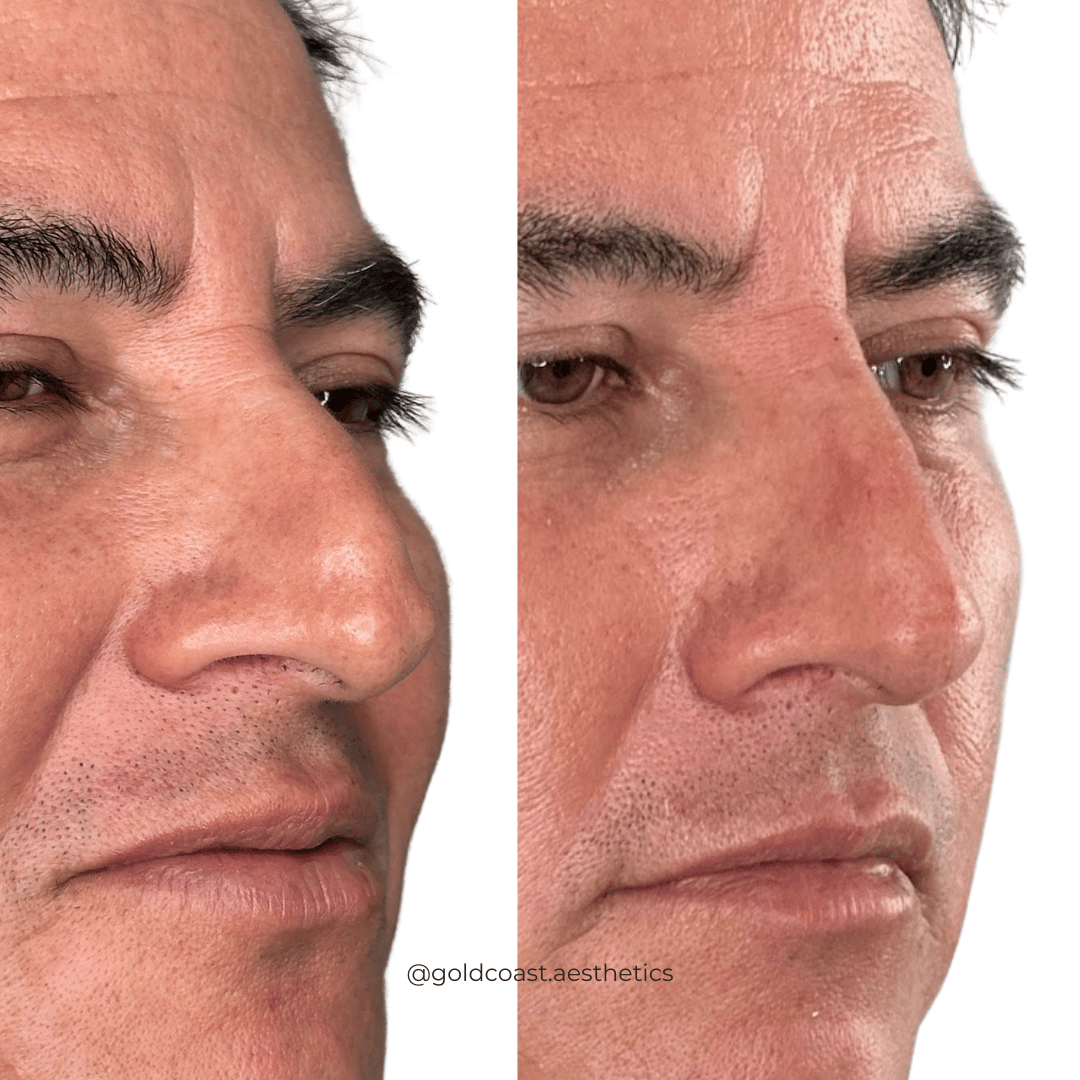Non-surgical nose reshaping results
