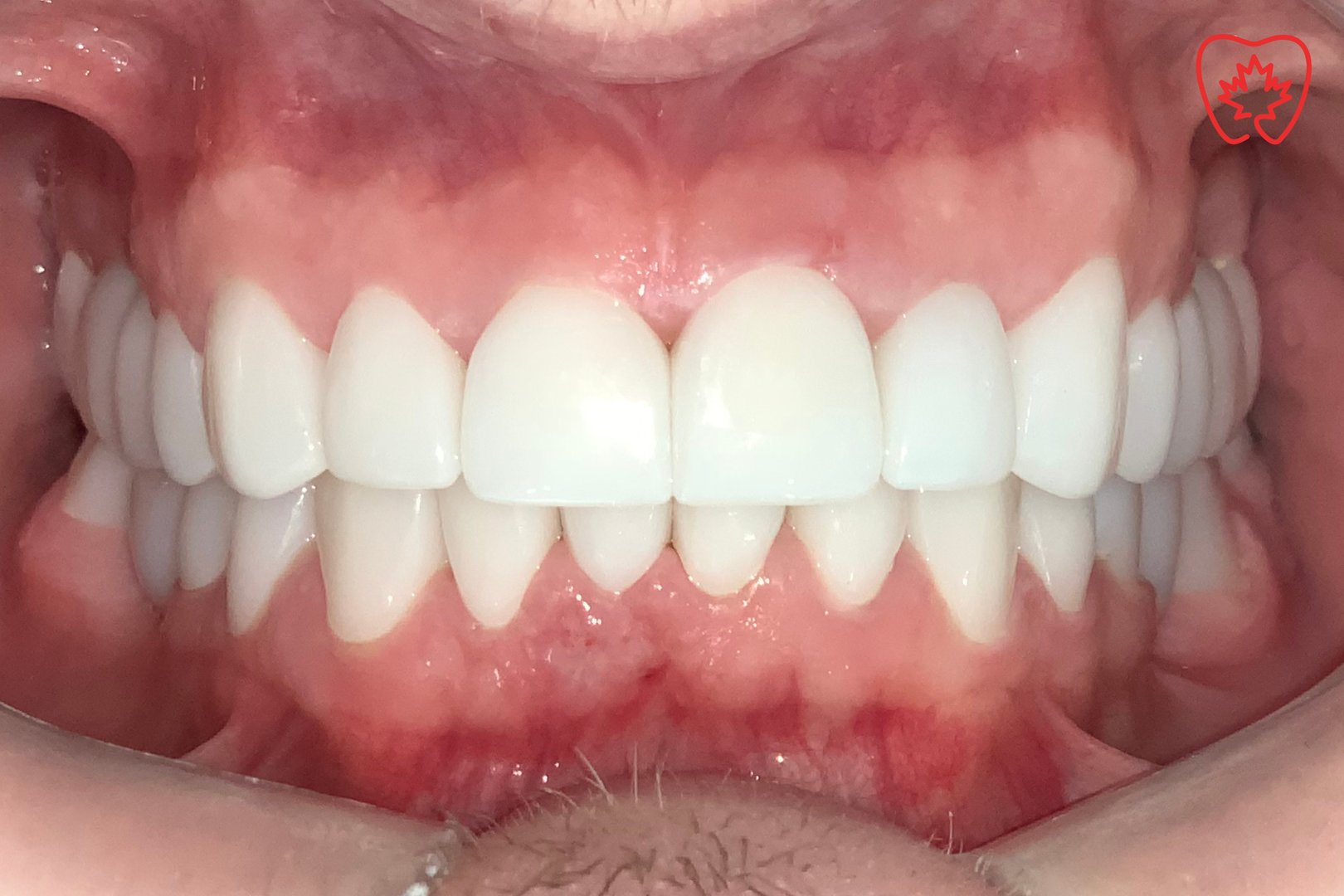 Carillas dentales - Transformación completa