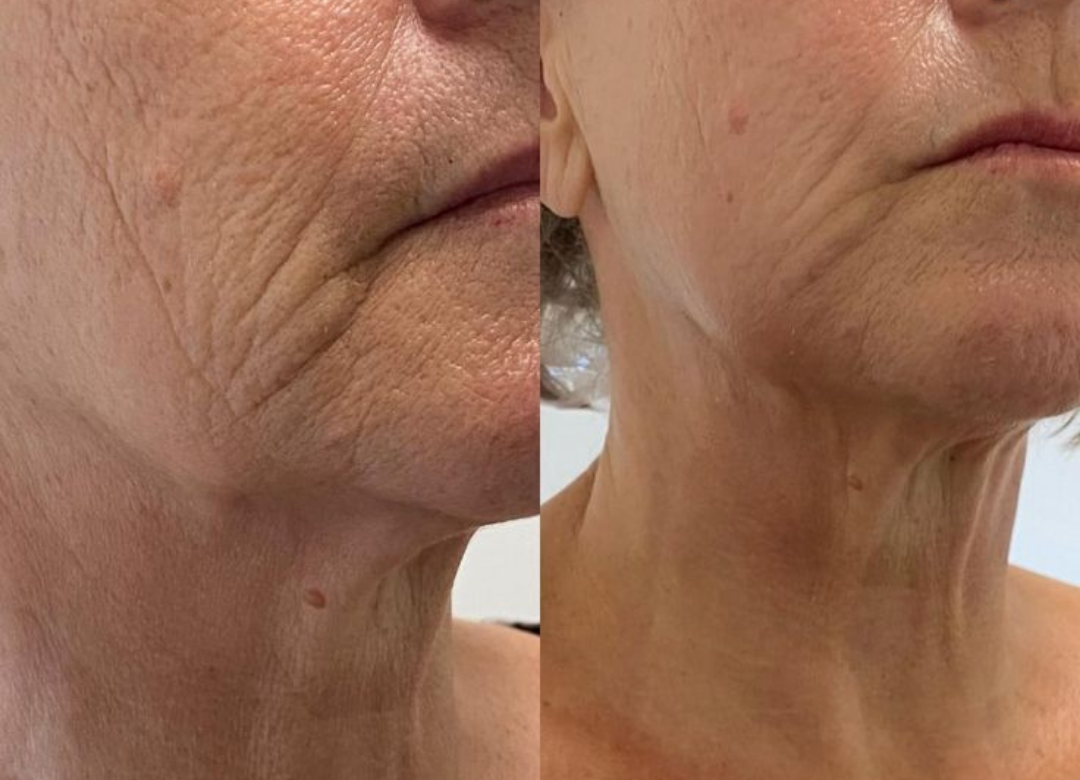 Efekt przed i po zabiegu HIFU - lifting twarzy