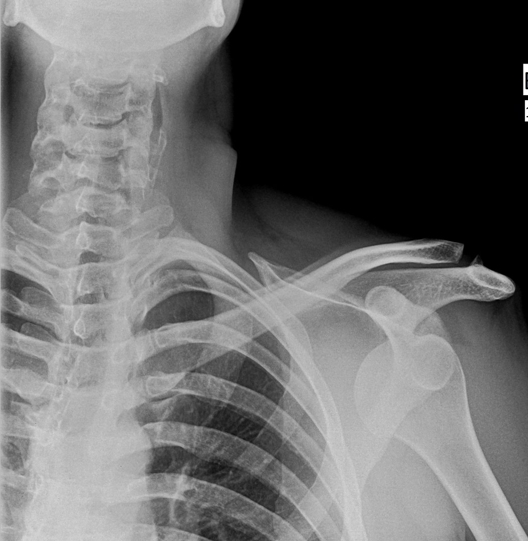 x ray shoulder radiograph show shoulder dislocation