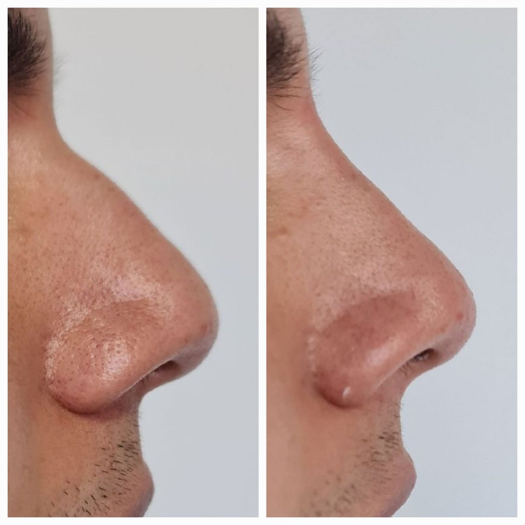 Resultado del tratamiento