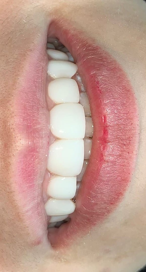 Después del tratamiento - Caso 2